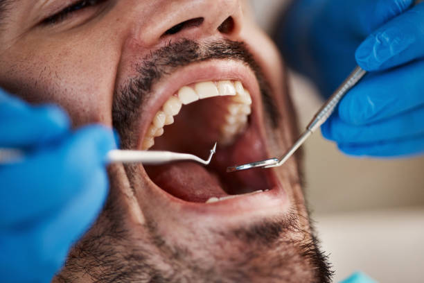 Best Emergency Dental Care for Broken or Chipped Teeth in Alton, IA